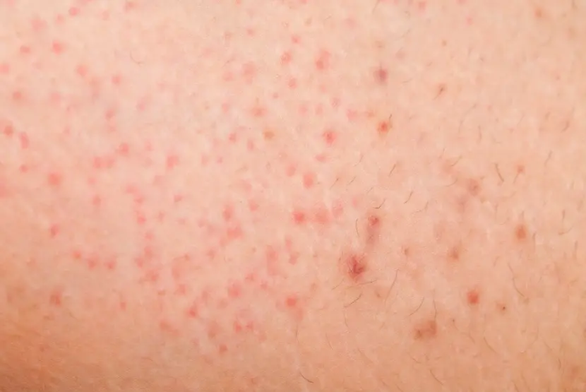 マラセチア毛包炎