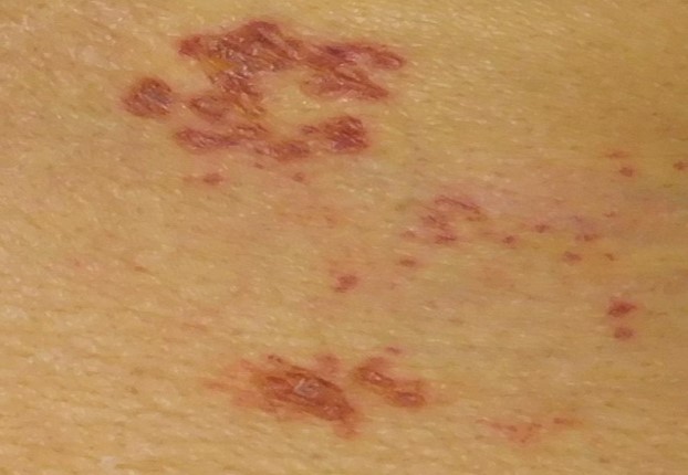 帯状疱疹の発疹