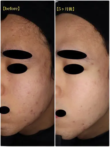 アゼライン酸症例画像