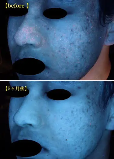 アゼライン酸症例画像