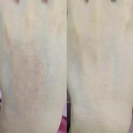 ダーマV酸症例画像