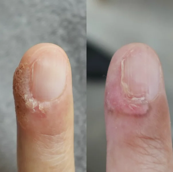 ダーマV症例画像