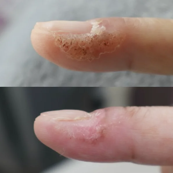 ダーマV症例画像