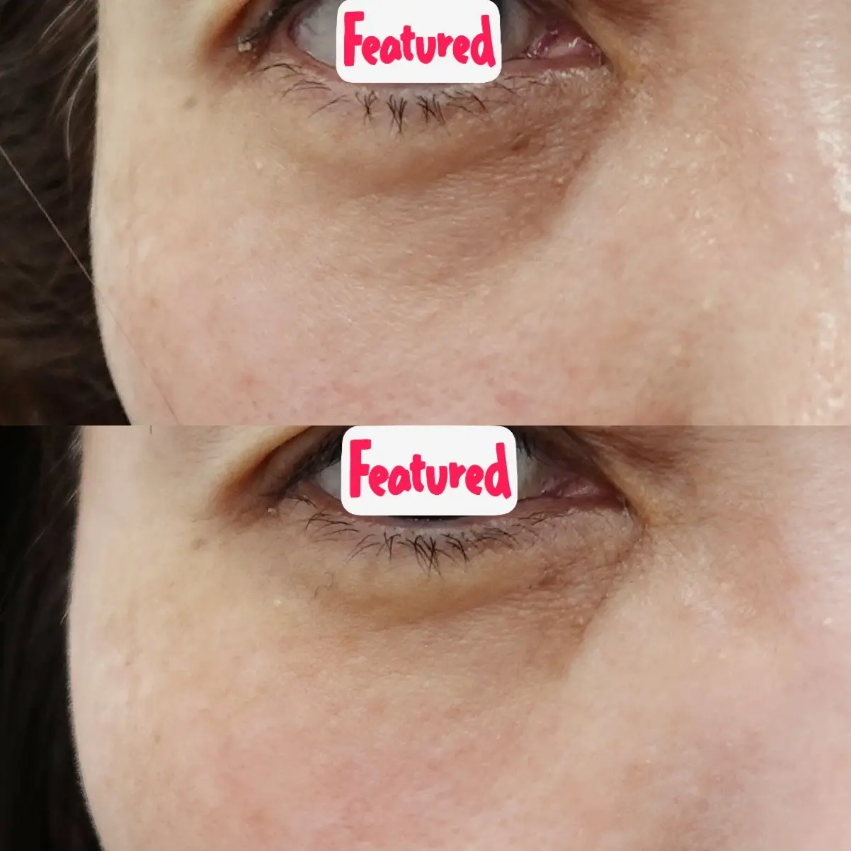 目の下のクマ画像