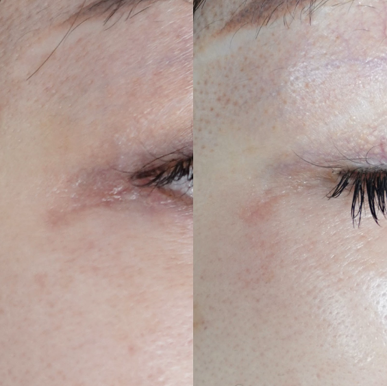 傷跡のへこみに対する当院での症例