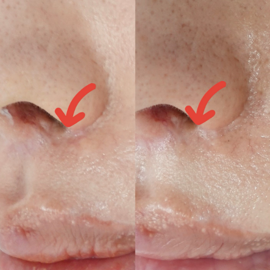 傷跡のへこみに対する当院での症例