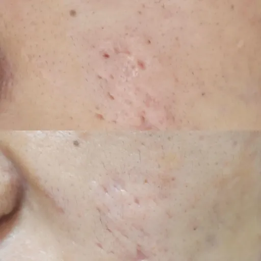 キュアジェットによる肥厚性瘢痕に対する当院での症例