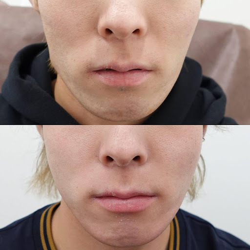 レニスナ症例画像