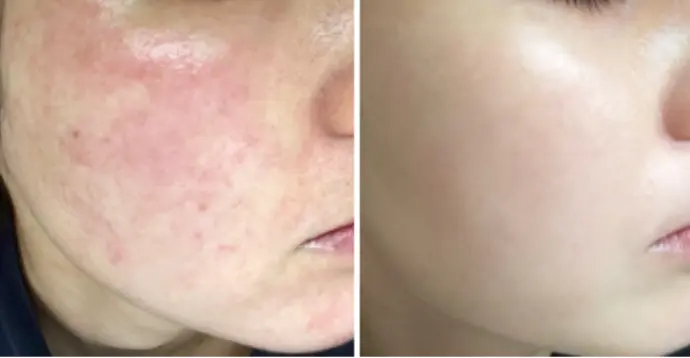 ナイアシンアミド