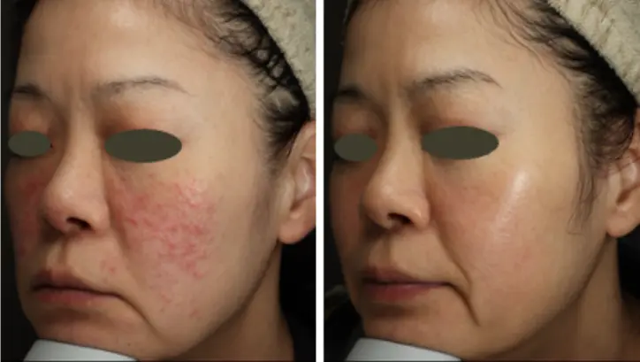 ナイアシンアミド