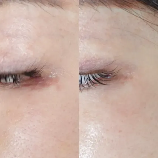 オペ後の傷跡に対する当院での症例