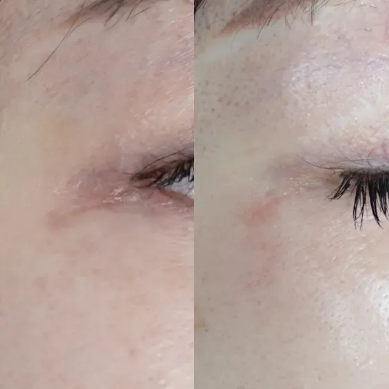 オペ後の傷跡に対する当院での症例