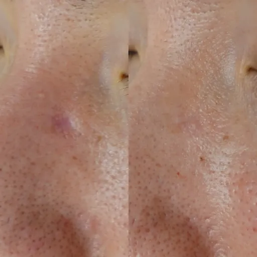 傷跡のへこみに対する当院での症例