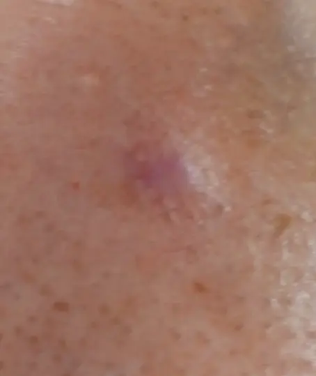 平坦な傷跡の原因とは