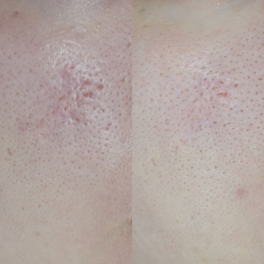 サブシジョン症例09