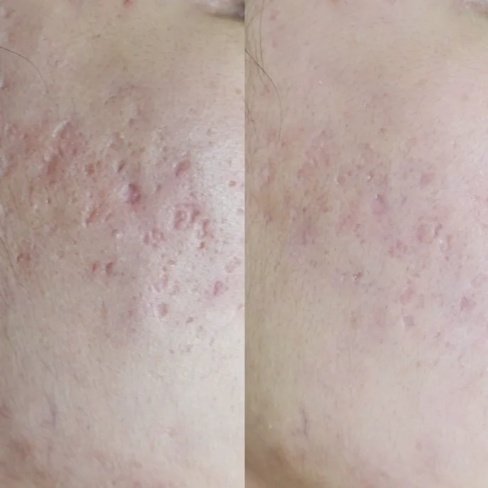 サブシジョン症例01