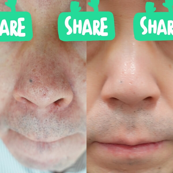 赤ら顔の症状例