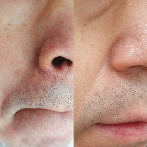 赤ら顔の症状例