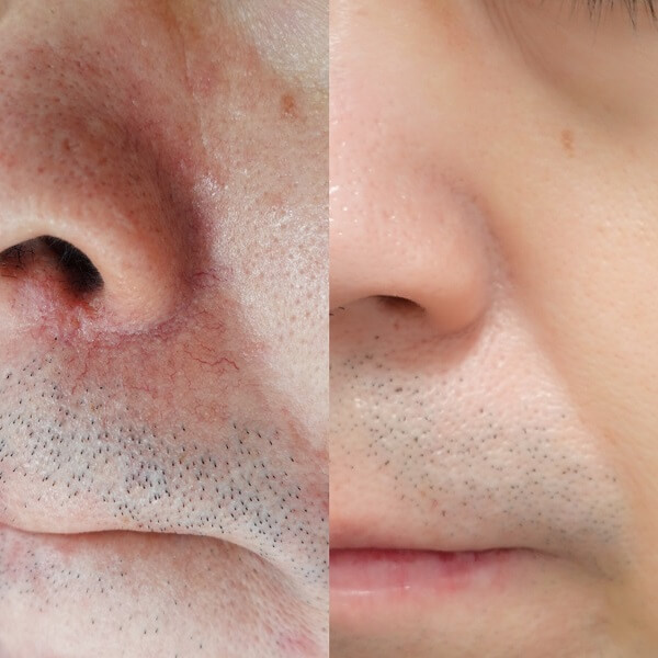 赤ら顔の症状例