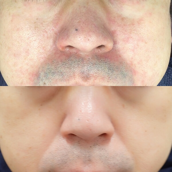 赤ら顔の症状例