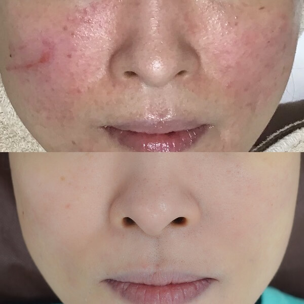 赤ら顔の症状例