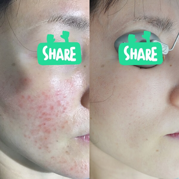 赤ら顔の症状例