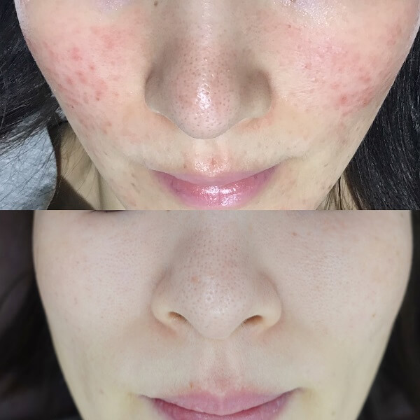 赤ら顔の症状例