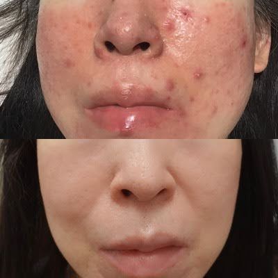 赤ら顔の症状例