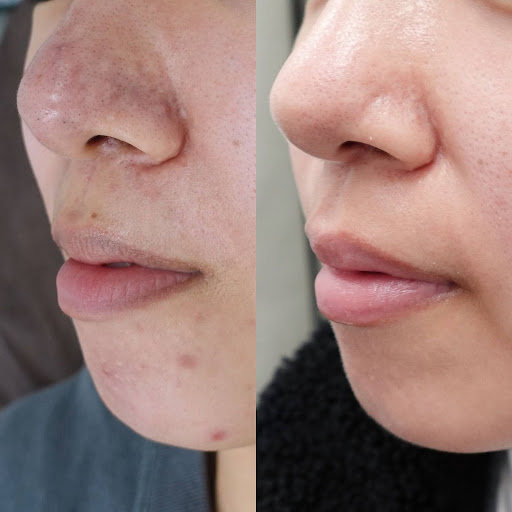 赤ら顔の症状例