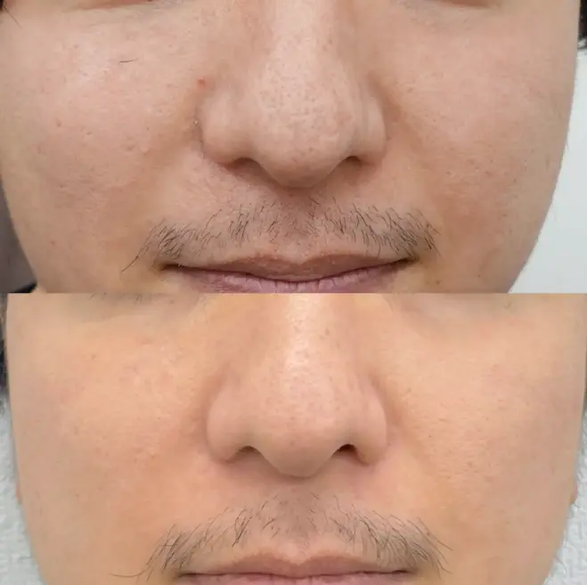 毛穴に対する当院での症例4
